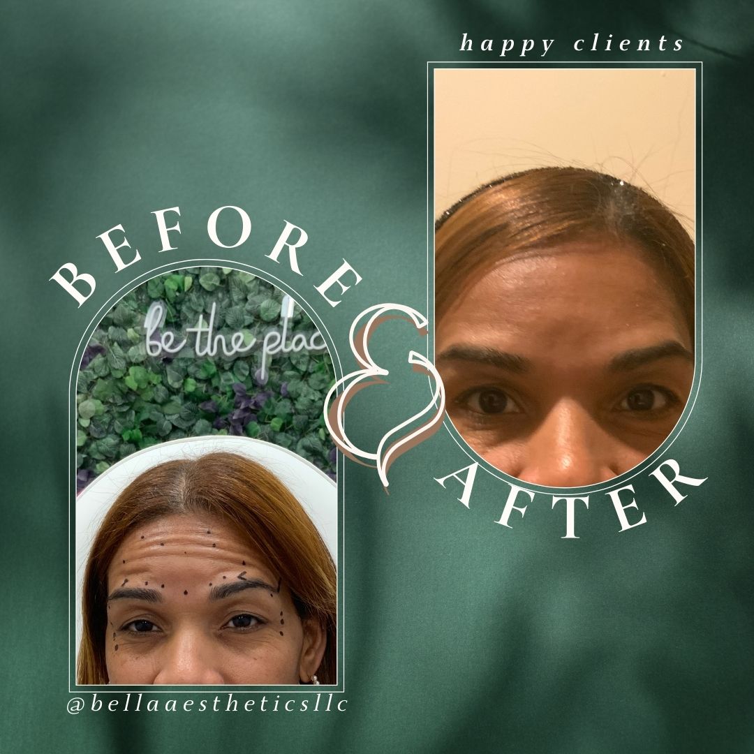 Before and after Botox treatment at Bella Aesthetics