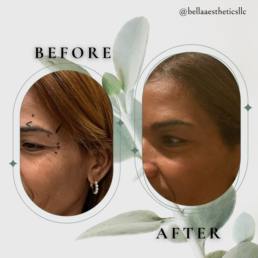 Before and after Botox treatment at Bella Aesthetics
