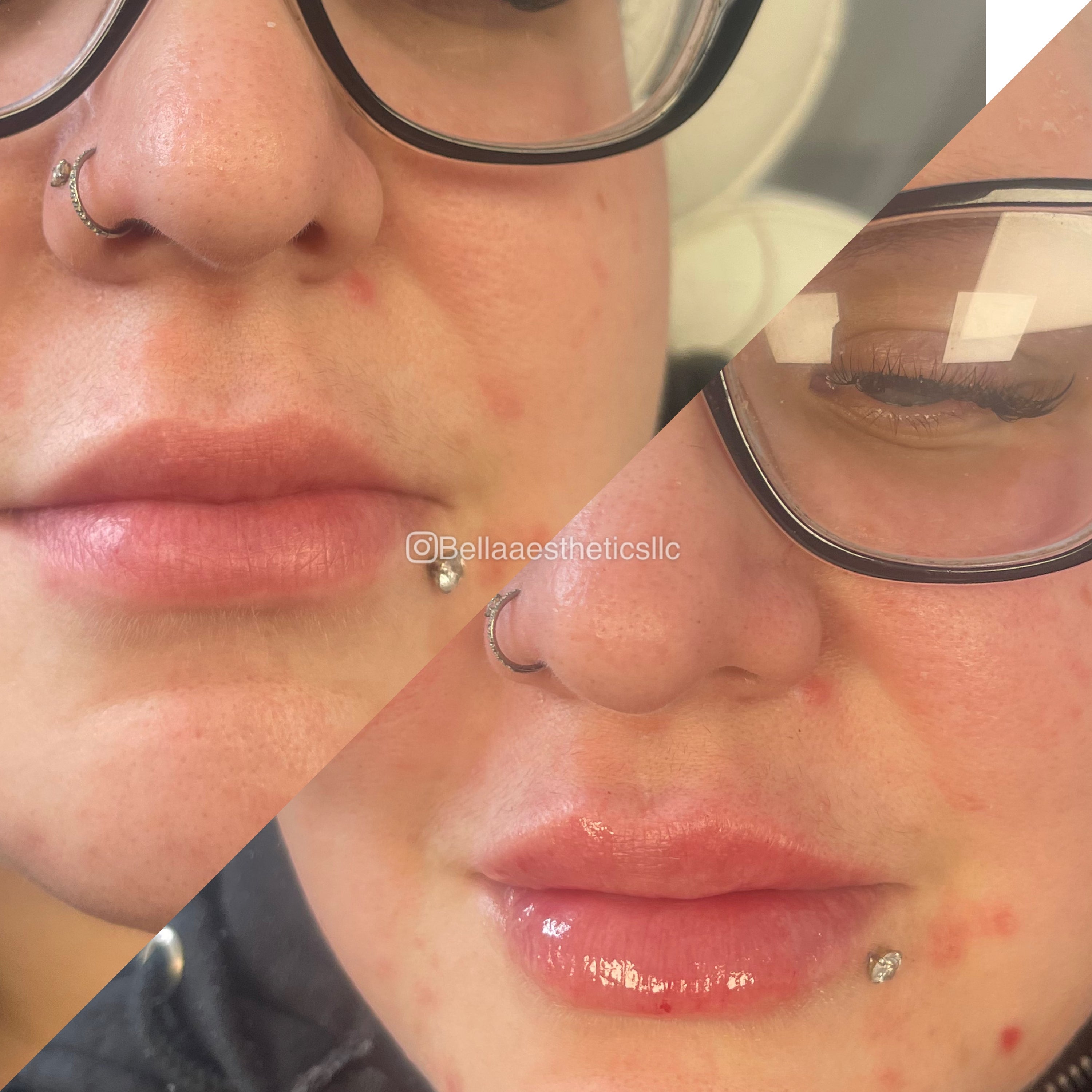 Lip filler results at Bella Aesthetics in Cambridge, MA