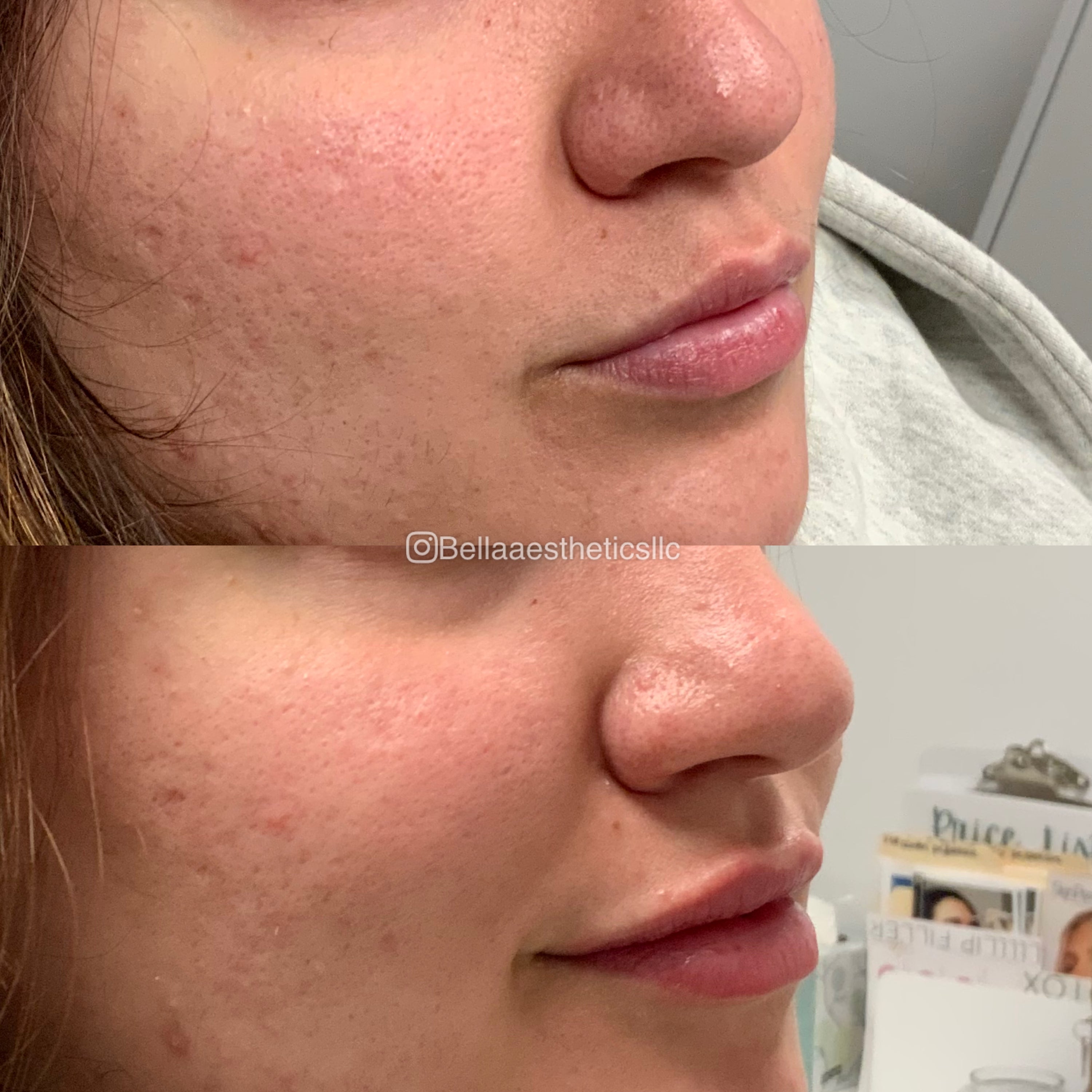 Lip filler results at Bella Aesthetics in Cambridge, MA